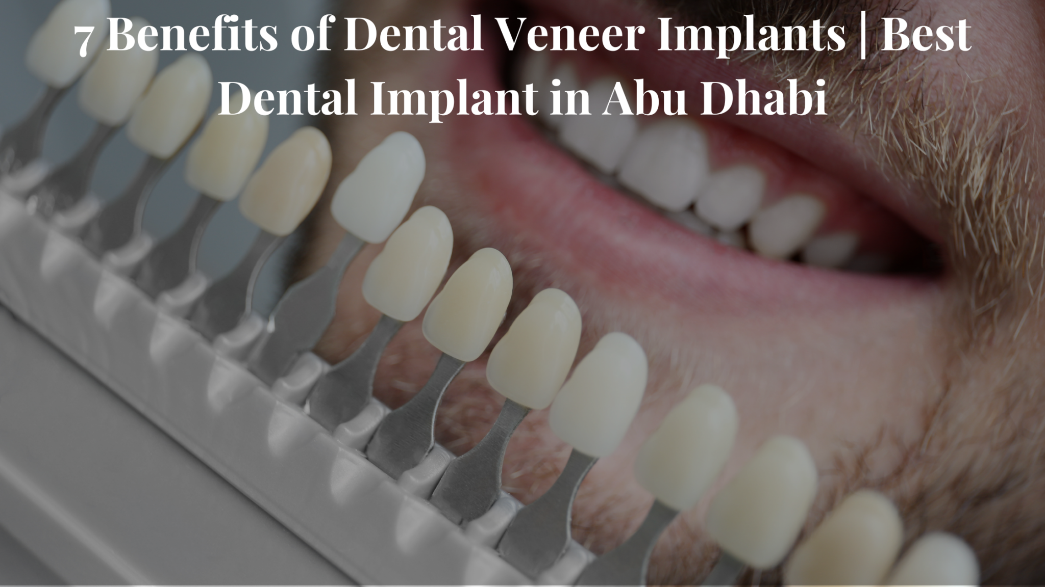 7 Benefits of Dental Veneer Implants | Best Dental Implant in Abu Dhabi