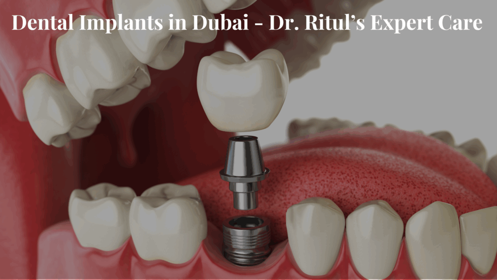 Dental Implants in Dubai: Dr. Ritul’s Expert Care​