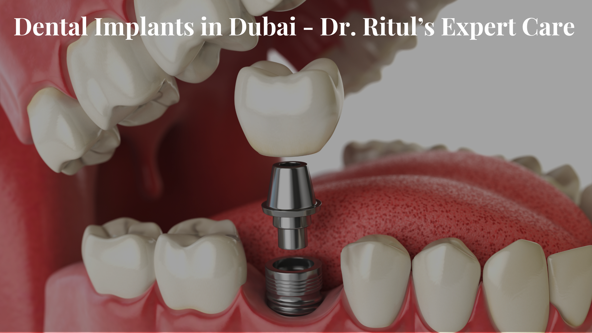 Dental Implants in Dubai: Dr. Ritul’s Expert Care​