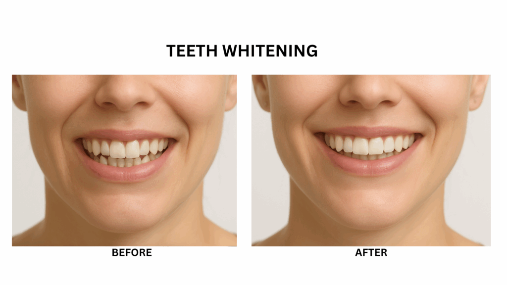 Before and after dental treatment showing improved tooth color and shape with cosmetic fillings
