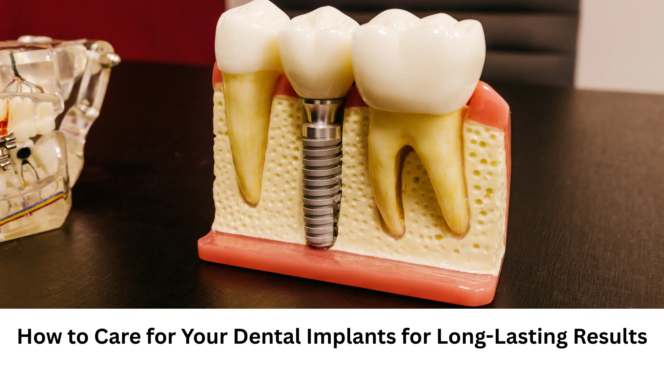Model of dental implants showing artificial tooth structure and gum anatomy