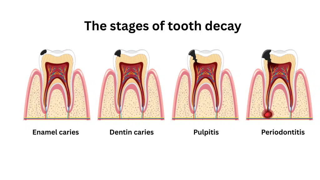 Stages of tooth decay – enamel caries, dentin caries, pulpitis, periodontitis before dental crown treatment