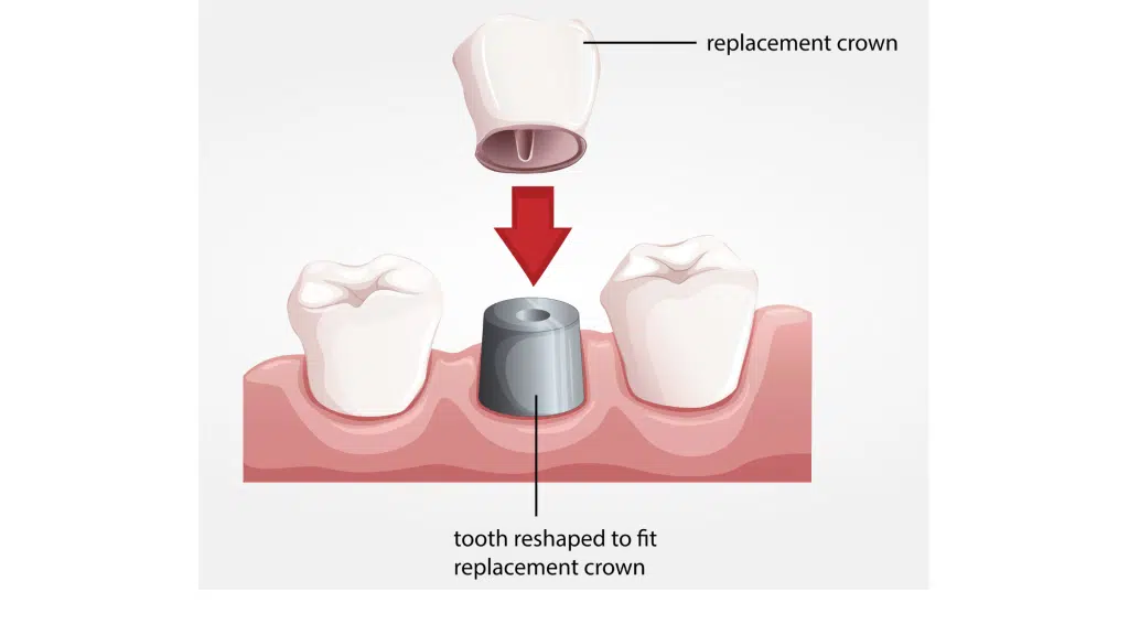 tooth reshaped to fit replacement dental crown