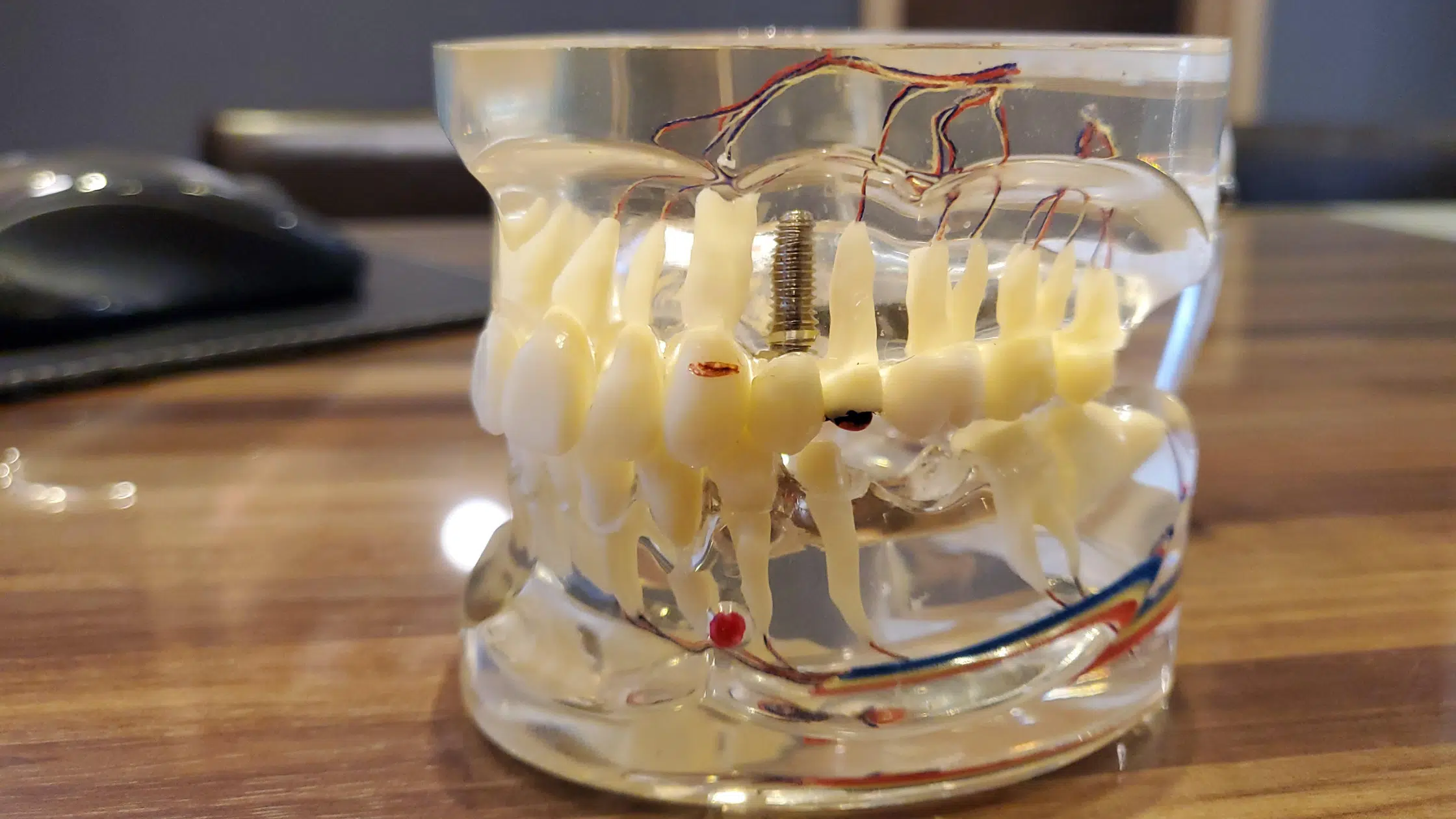 Transparent dental model showing dental implant placement and nerve pathways