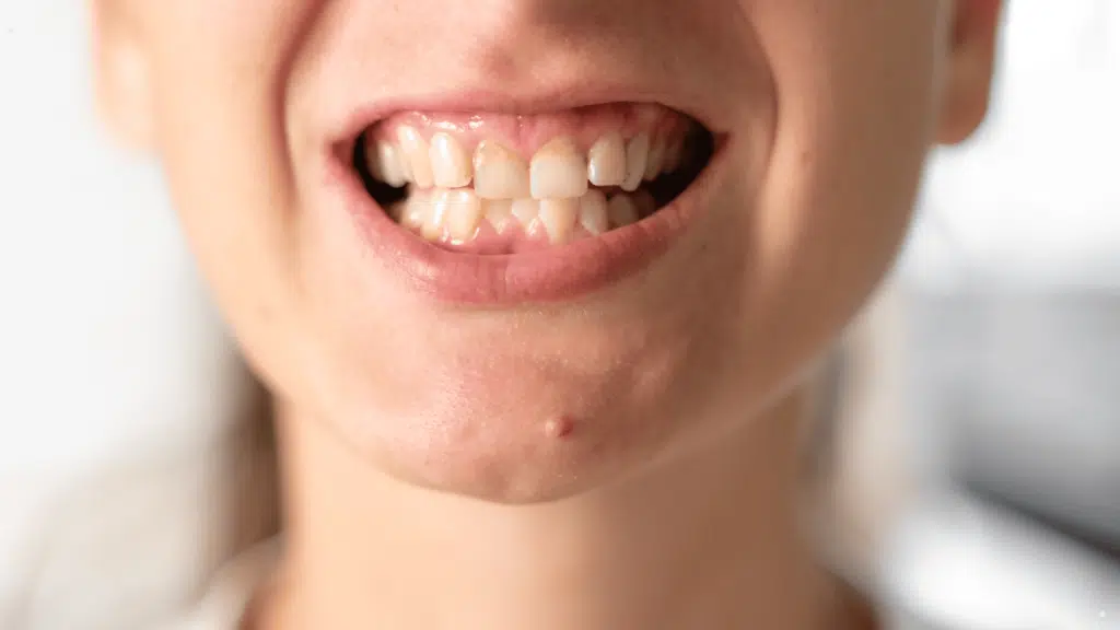 Teeth Grinding Treatment in Motor City