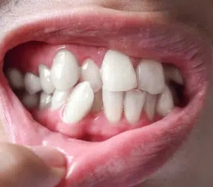 teeth-grinding-treatment-in-motor-city-1