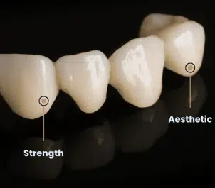 Dental Veneers
