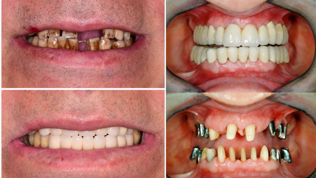 The Best Solution for Missing Teeth