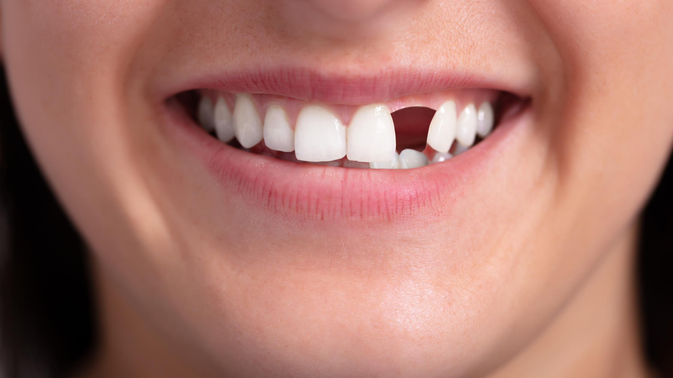 Missing Teeth Replacement