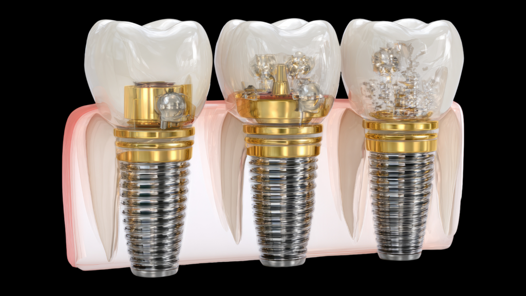 Dental Implants in Dubai by Dr Ritul agarwal the smile rehabilitator