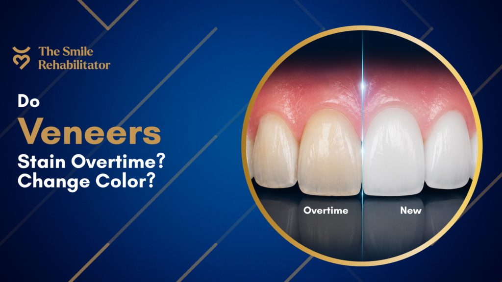 Can veneers stain or change color overtime?