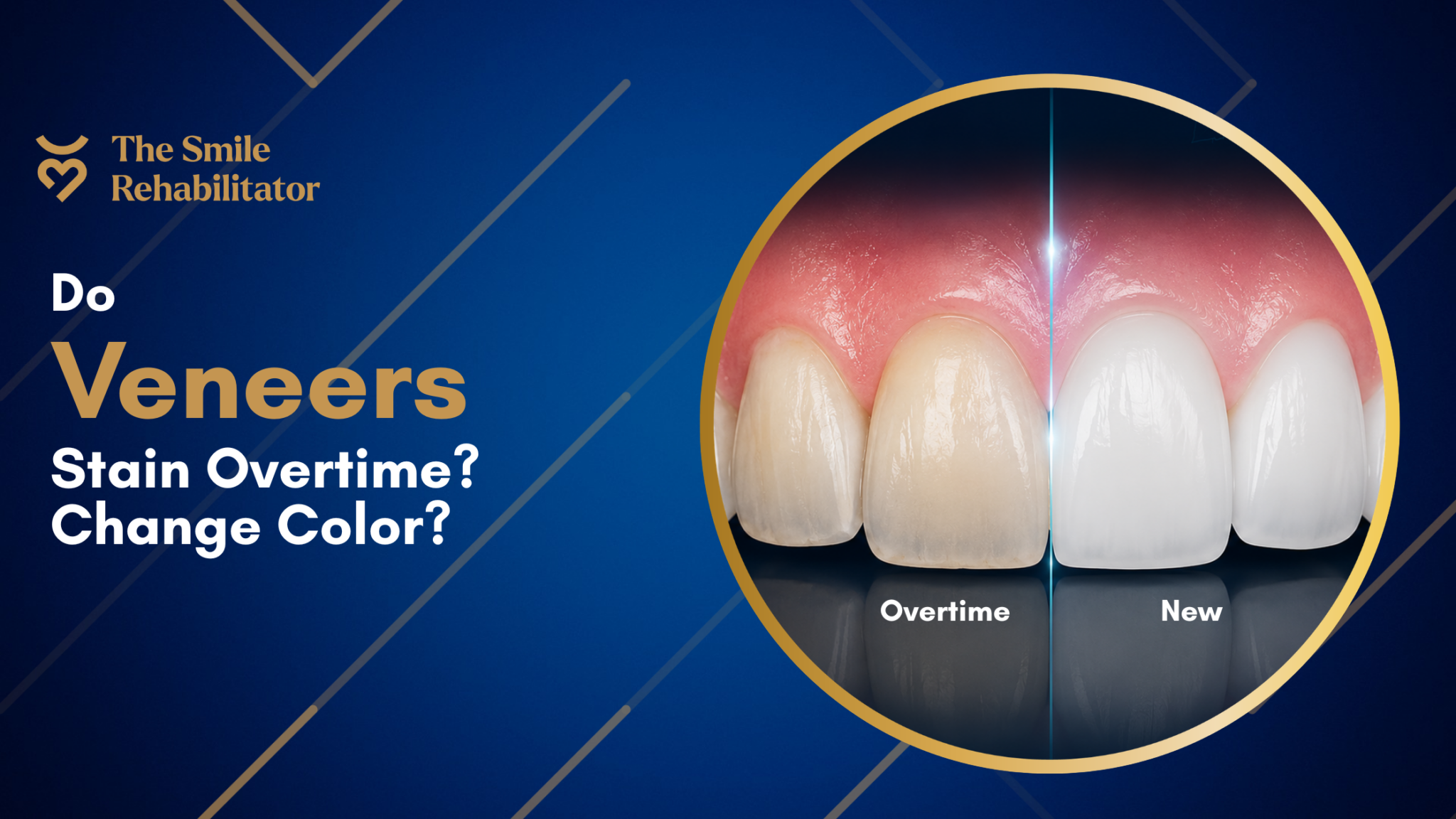 Do Veneers Stain or change color over time?